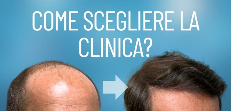 Migliori clincihe trapianto capelli Italia